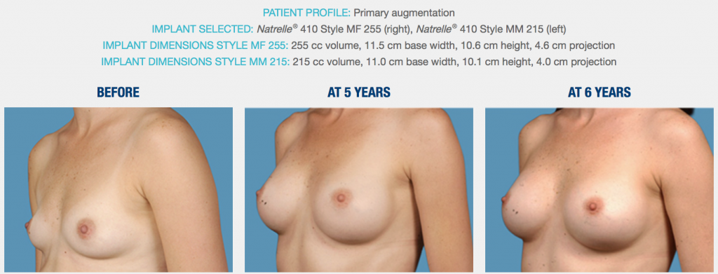 natural breast augmentation
