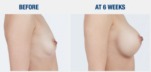 Natrelle Inspira Breast Implants 