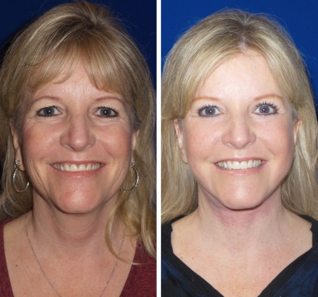 Facelift Newport Beach