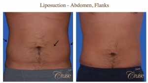 liposuction for men