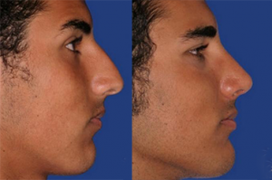 rhinoplasty before and after orange county