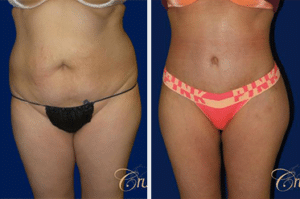 tummy tuck before and after