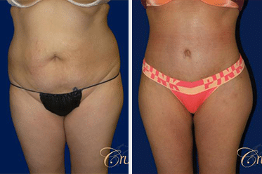 tummy tuck before and after