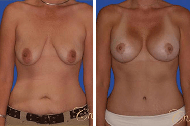 Mommy makeover recovery in Orange County at Cruise Plastic Surgery | LA, California