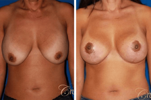 breast revision los angeles