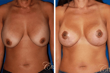 breast revision los angeles