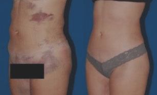 liposuction before and after