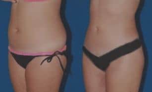 liposuction before and after