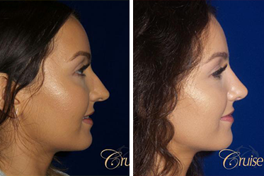 Rhinoplasty Recovery in Los Angeles | Orange County Cosmetic Surgery