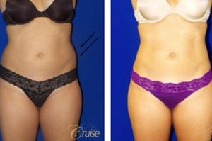 liposuction newport beach