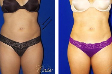 liposuction newport beach