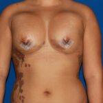 highbreastimplants