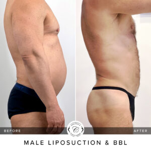 This procedure offers a more natural option to enhance the buttocks. Not only do results appear natural, but there is also no need to use foreign substances such as implants.