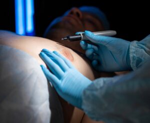 male liposuction prep