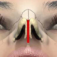 3-columellar-strut