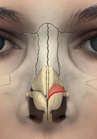 8-enlarged-alar-cartilage-excision