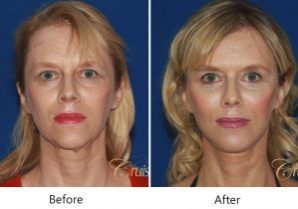 Before-After1