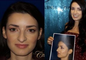 Rhinoplasty before after gallery