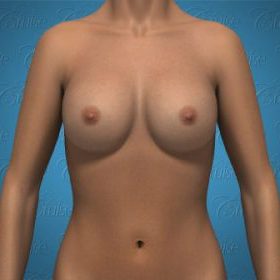 Implants Complete Muscle Coverage