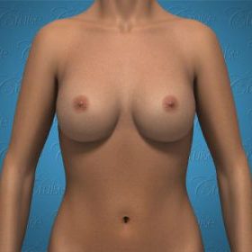 Implants Complete Muscle Coverage high