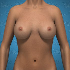 Implant Partial Muscle Coverage Low Placement