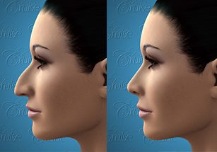 Overview of Rhinoplasty