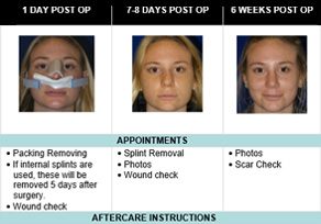 Rhinoplasty Recovery Timeline