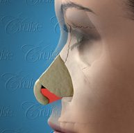 enlarged-membrenous-septum-text